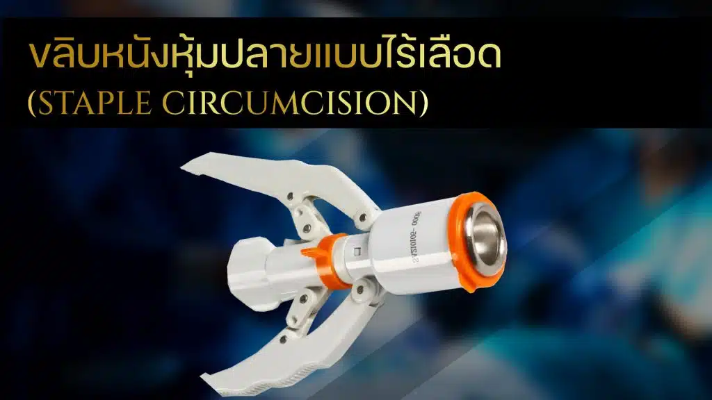 การขลิบไร้เลือด(Staple Circumcision)